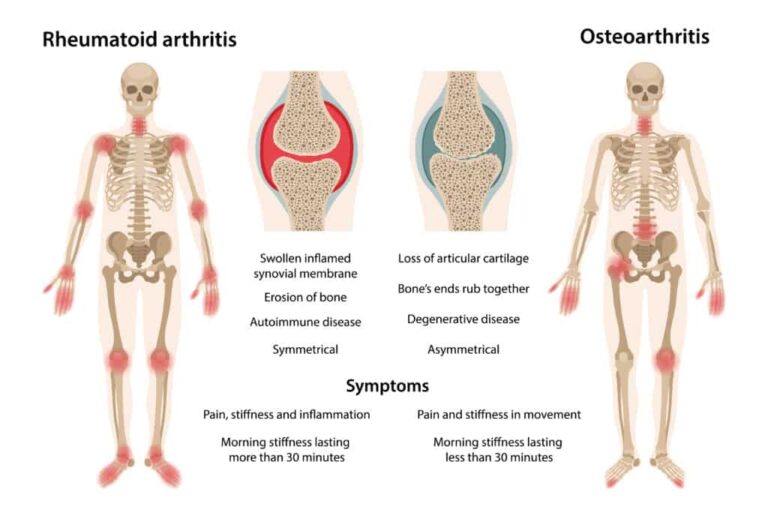 Beyond the Joints: How Rheumatoid Arthritis Affects Your Whole Body