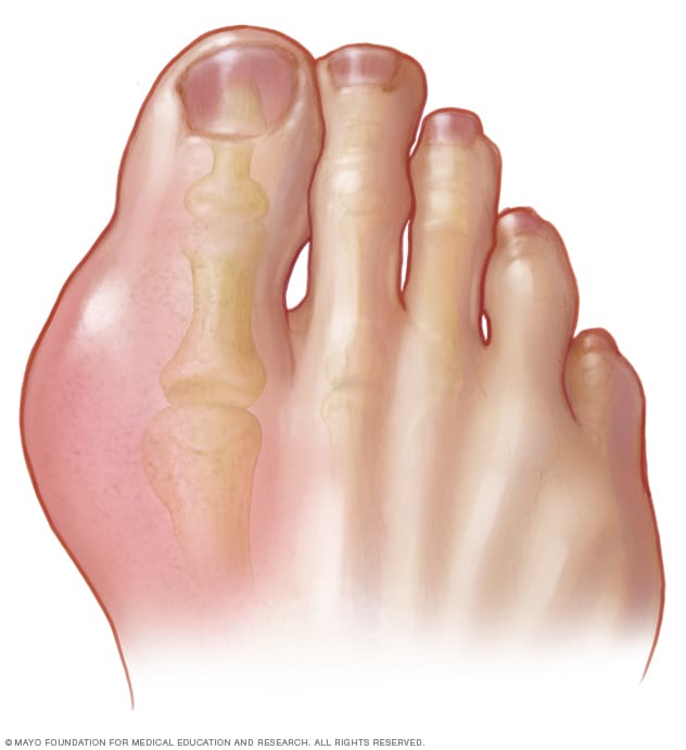 The Silent Siege: Why Gout Loves Your Big Toe (and Other Joints) – A Podiatrist’s Chronicle
