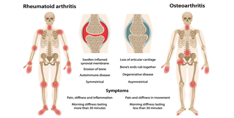 The Whispers and Roars of the Joints: A Journey to Clarity on Rheumatoid Arthritis and Osteoarthritis