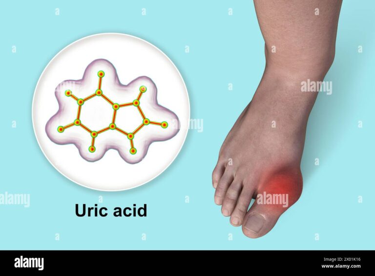 What Exactly Is Gout? Breaking Down the Uric Acid Crystal Crisis