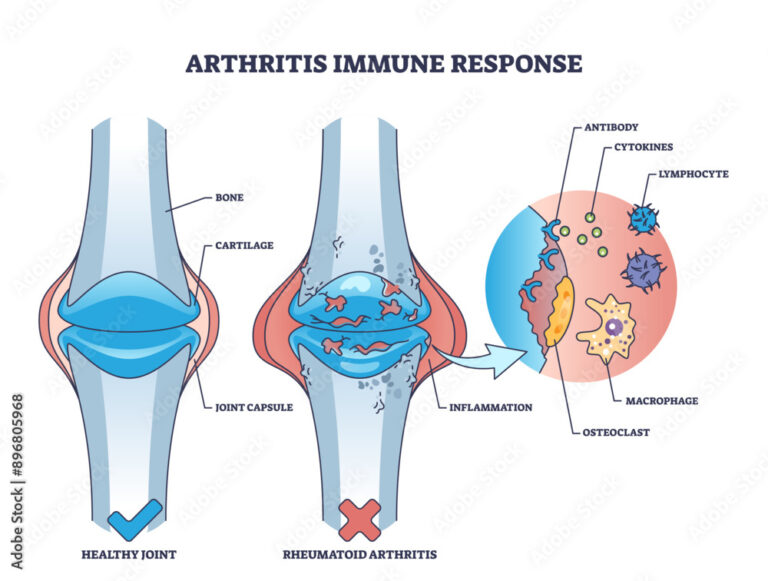 When Your Immune System Attacks: A Simple Guide to Rheumatoid Arthritis